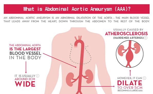 What are the causes of an enlarged abdominal aorta?